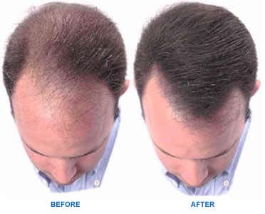 vs_cosmetics_hair_loss_treatment